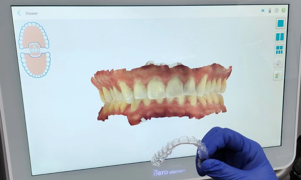 Invisalign with Digital Scanning