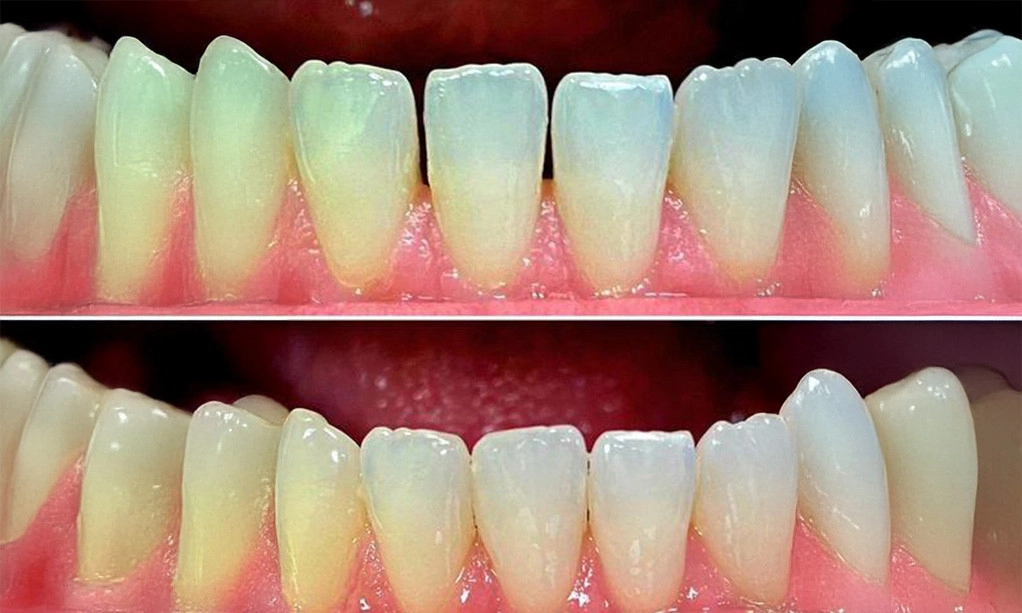 Tooth Coloured Fillings